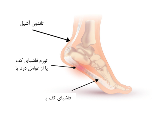 علل درد پاشنه پا در افراد