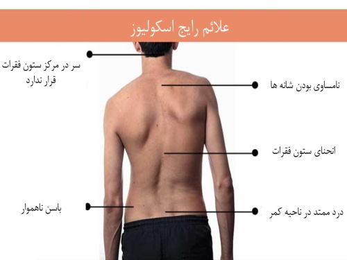 علائم اسکولیوز در فرد بیمار