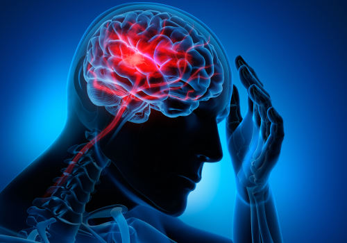 سکته مغزی چیست؟ علائم، تشخیص و درمان