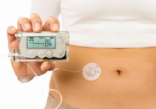 استفاده از پمپ های انسولین برای مدیریت دیابت نوع دو