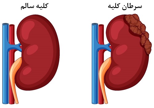 سرطان کلیه چیست؟ علائم، دلایل و درمان
