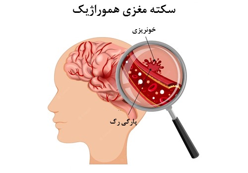 درمان حمله مغزی هموراژیک