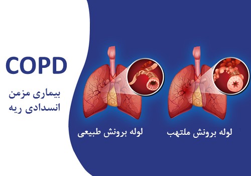 بیماری مزمن انسدادی ریه (COPD) چیست