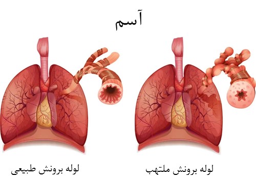 آسم چیست؟ دلایل، علائم و درمان
