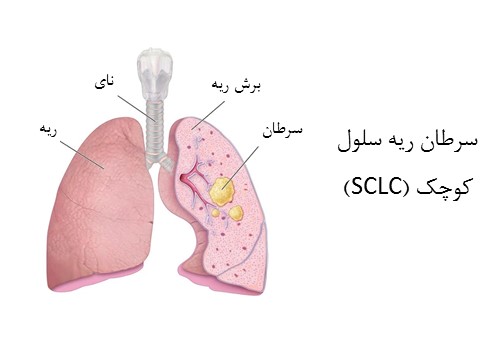 سلول ریه کوچک (SCLC)