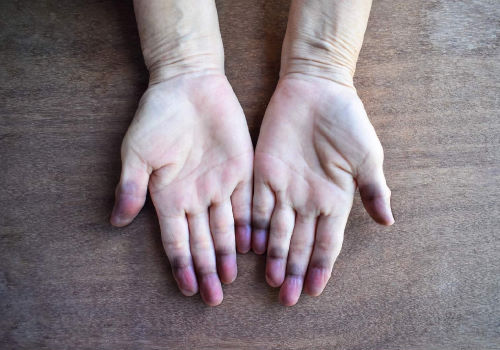 کبودی نوک انگشتان دست یکی از علائم سیانوز محیطی