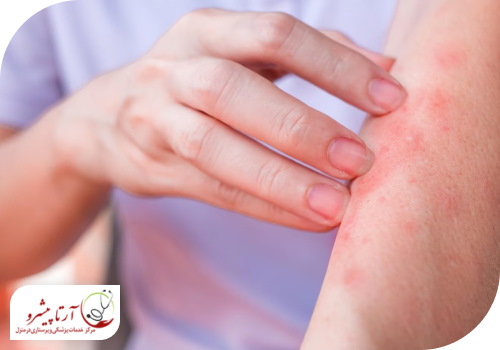دلایل اگزمای آتوپیک