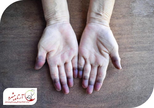 سیانوز یکی از علائم کمبود اکسیژن خون
